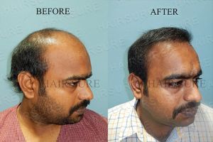 Results of Hair Clinic in Hyderabad