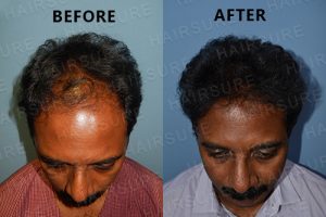 hair Treatment Results