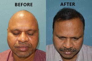 Advanced Hair Clinic Results