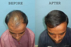 Hair Transplant Clinic Results