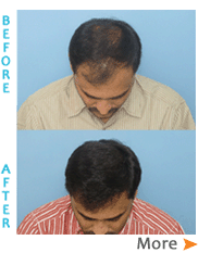 hair transplantation clinic hyderabad Dr Madhu's Advanced Hair Transplant Centre