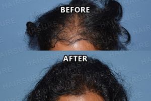 Results of Hair Clinic