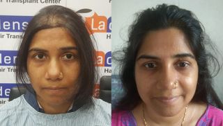 hair transplantation clinic lucknow La Densitae Hair Transplant Clinic in Lucknow