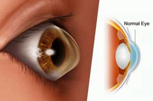 paediatric ophthalmologist lucknow Vinayak Netralaya, Dr Ajay Prakash, Eye Specialist Surgeon, Cataract, LASIK, ICL, Cornea Surgery Lucknow