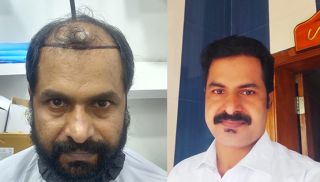 hair transplantation clinic lucknow La Densitae Hair Transplant Clinic in Lucknow